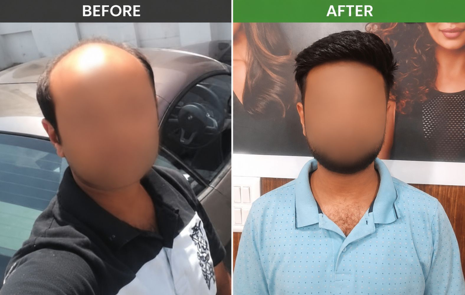 Smart Square Hair Fixing real men's before and after hair patch result