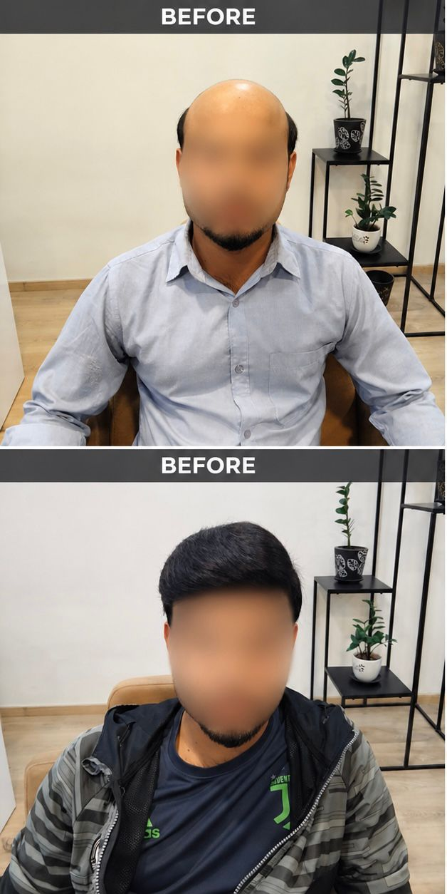 Smart Square Hair Fixing real men's full coverage before and after result