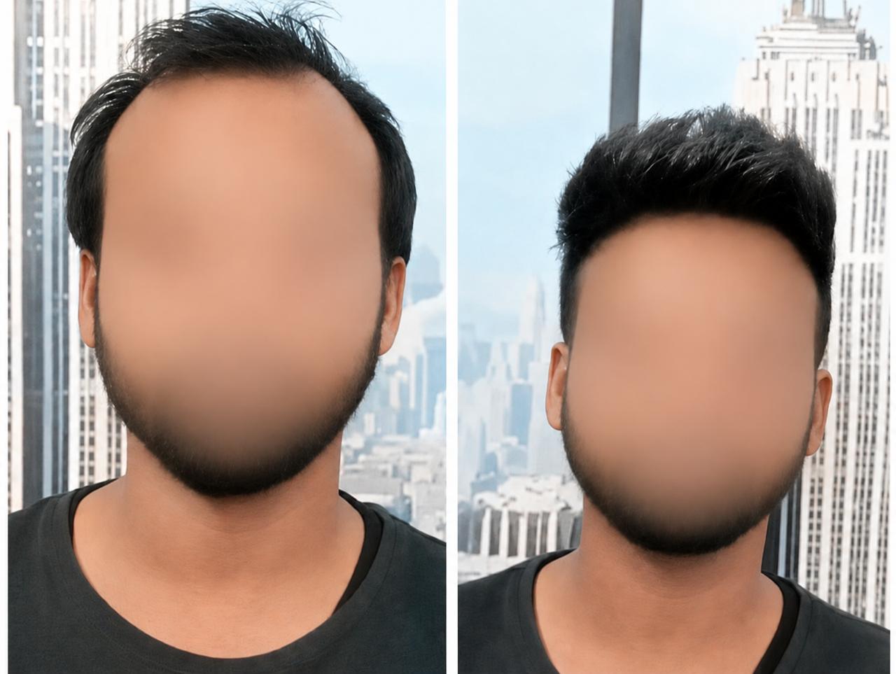 Smart Square Hair Fixing real before and after hair patch result