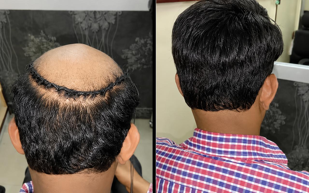 Smart Square Hair Fixing real before and after hair weaving result